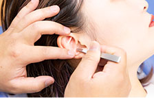 耳鍼施術